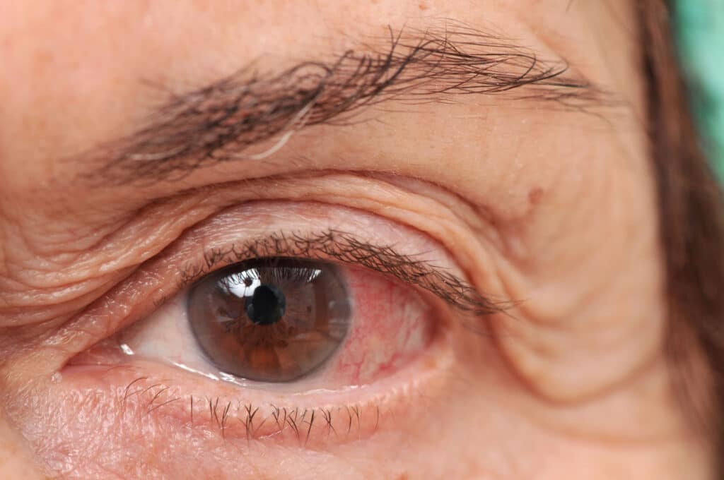 Community based care can provide aging veterans with vision issues the care and support in their home.